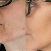 Maya Chia The Straight A Serum Advanced Gentle Retinol Srum Results